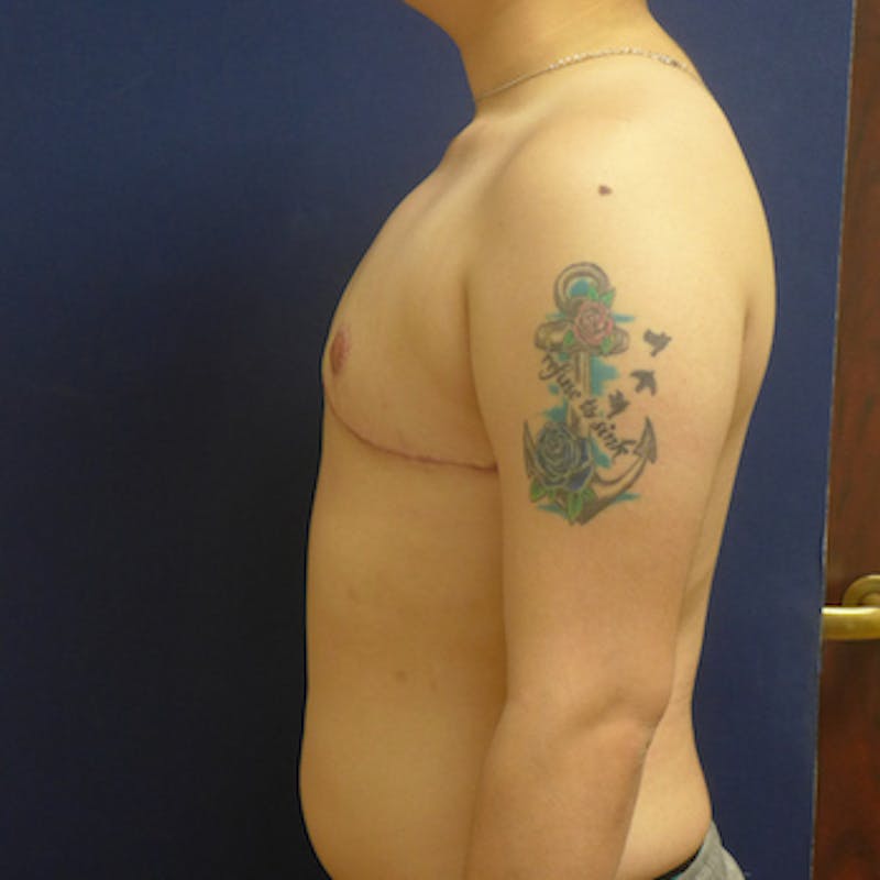 Masculinizing Surgery Before & After Gallery - Patient 365380 - Image 2