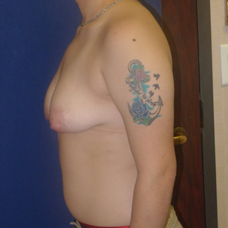 Masculinizing Surgery Before & After Gallery - Patient 365380 - Image 1
