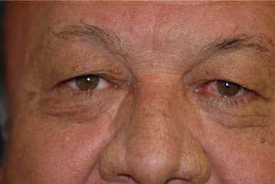 Eyelid Lift (Blepharoplasty) Before & After Gallery - Patient 383111 - Image 1