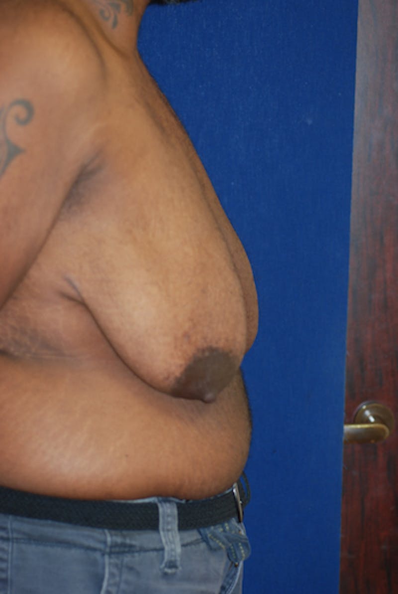 Masculinizing Surgery Before & After Gallery - Patient 156671 - Image 1
