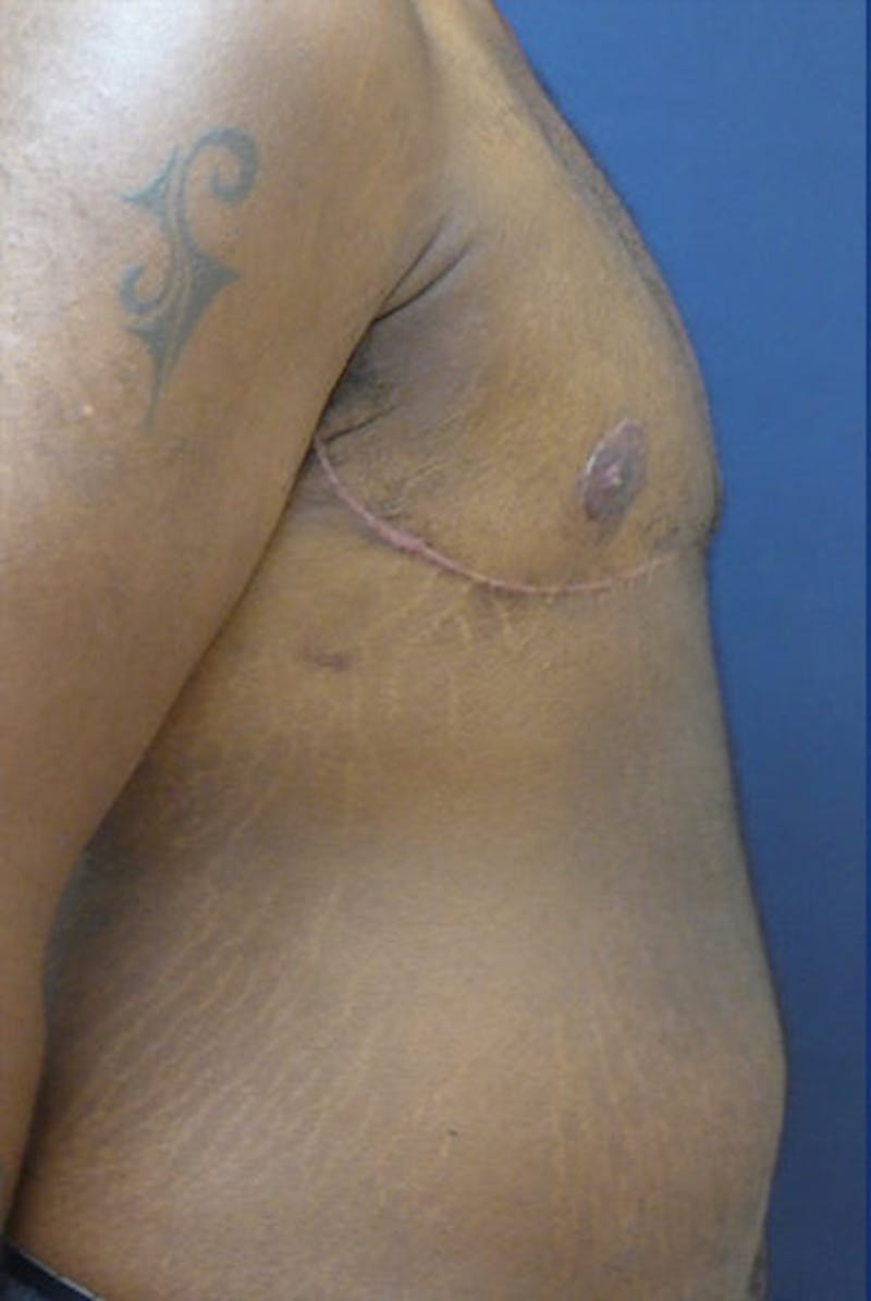 Masculinizing Surgery Before & After Gallery - Patient 156671 - Image 2