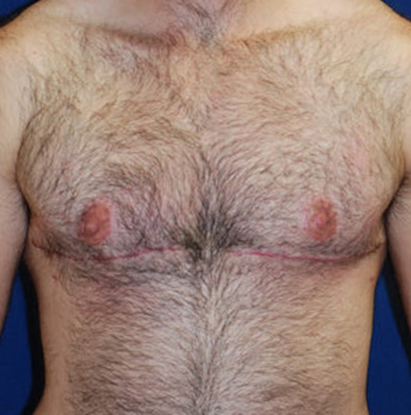 Masculinizing Surgery Before & After Gallery - Patient 200060 - Image 2