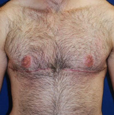 Masculinizing Surgery Before & After Gallery - Patient 200060 - Image 2