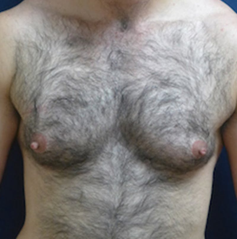 Masculinizing Surgery Before & After Gallery - Patient 200060 - Image 1