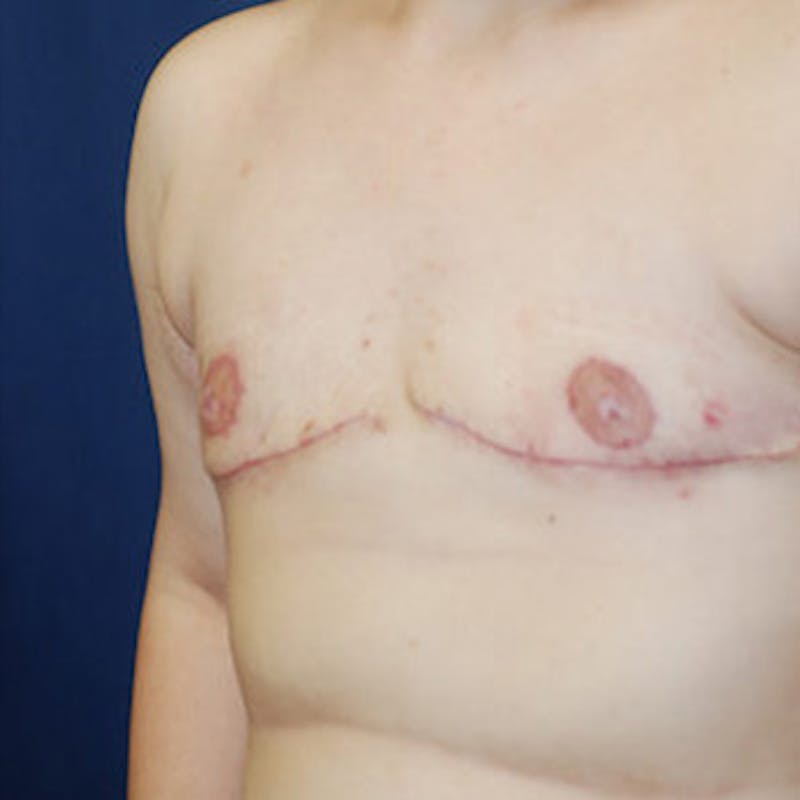 Masculinizing Surgery Before & After Gallery - Patient 416315 - Image 2