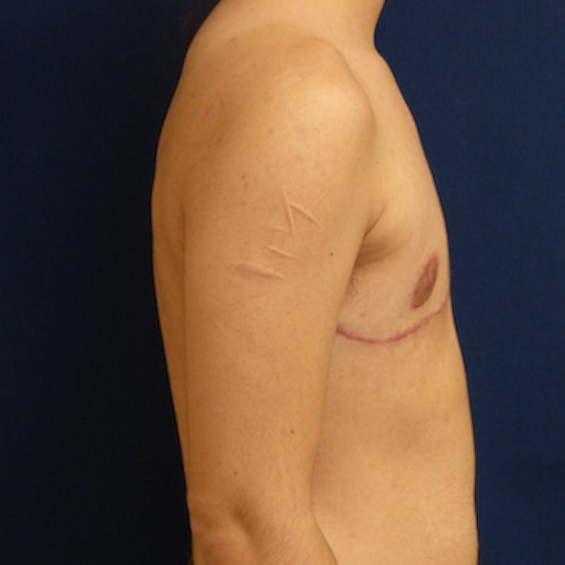 Masculinizing Surgery Before & After Gallery - Patient 218531 - Image 2