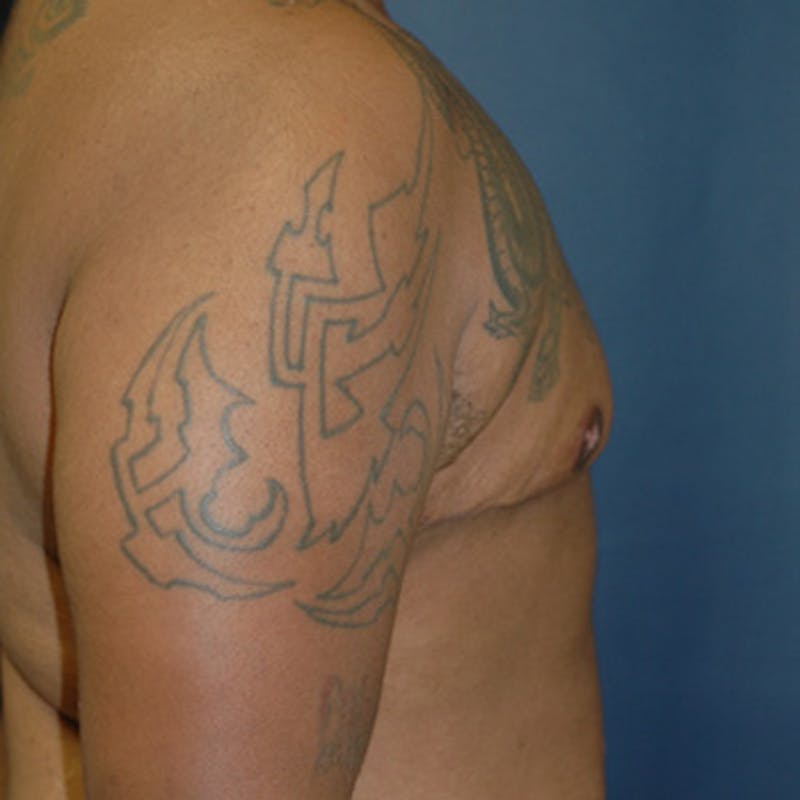 Masculinizing Surgery Before & After Gallery - Patient 183082 - Image 2