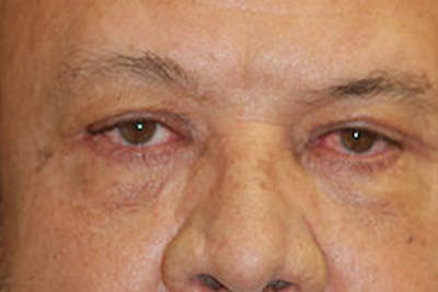 Eyelid Lift (Blepharoplasty) Before & After Gallery - Patient 383111 - Image 2