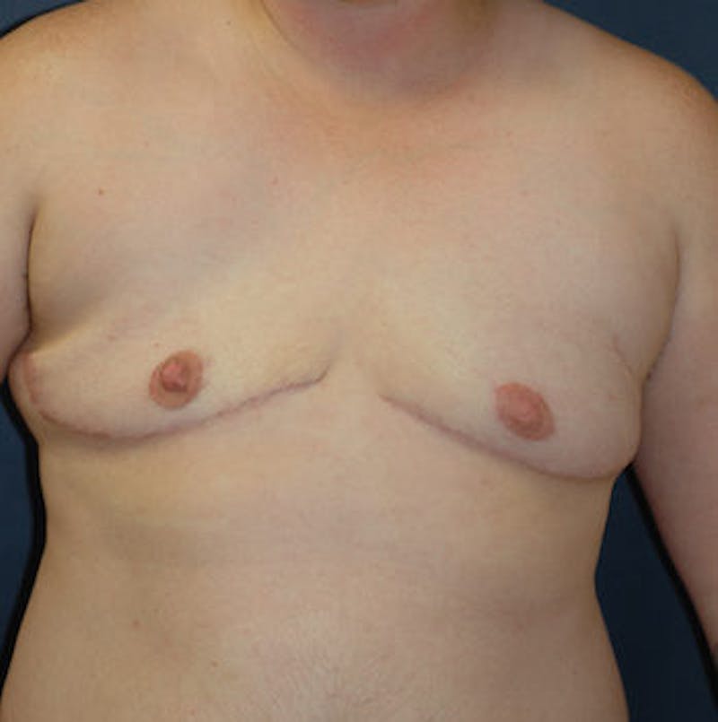 Masculinizing Surgery Before & After Gallery - Patient 366639 - Image 2