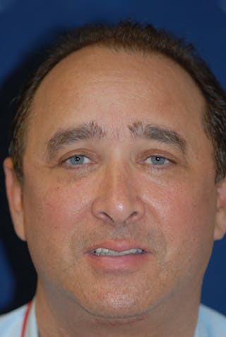 Facelift Before & After Gallery - Patient 358086 - Image 2