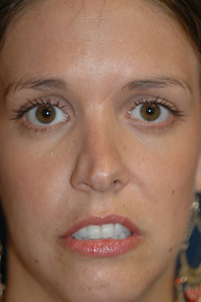 Rhinoplasty Before & After Gallery - Patient 402107 - Image 1