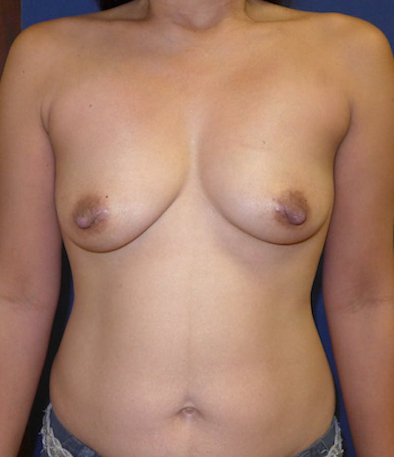Breast Augmentation Before & After Gallery - Patient 369398 - Image 1