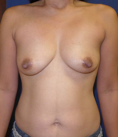 Breast Augmentation Before & After Gallery - Patient 369398 - Image 1