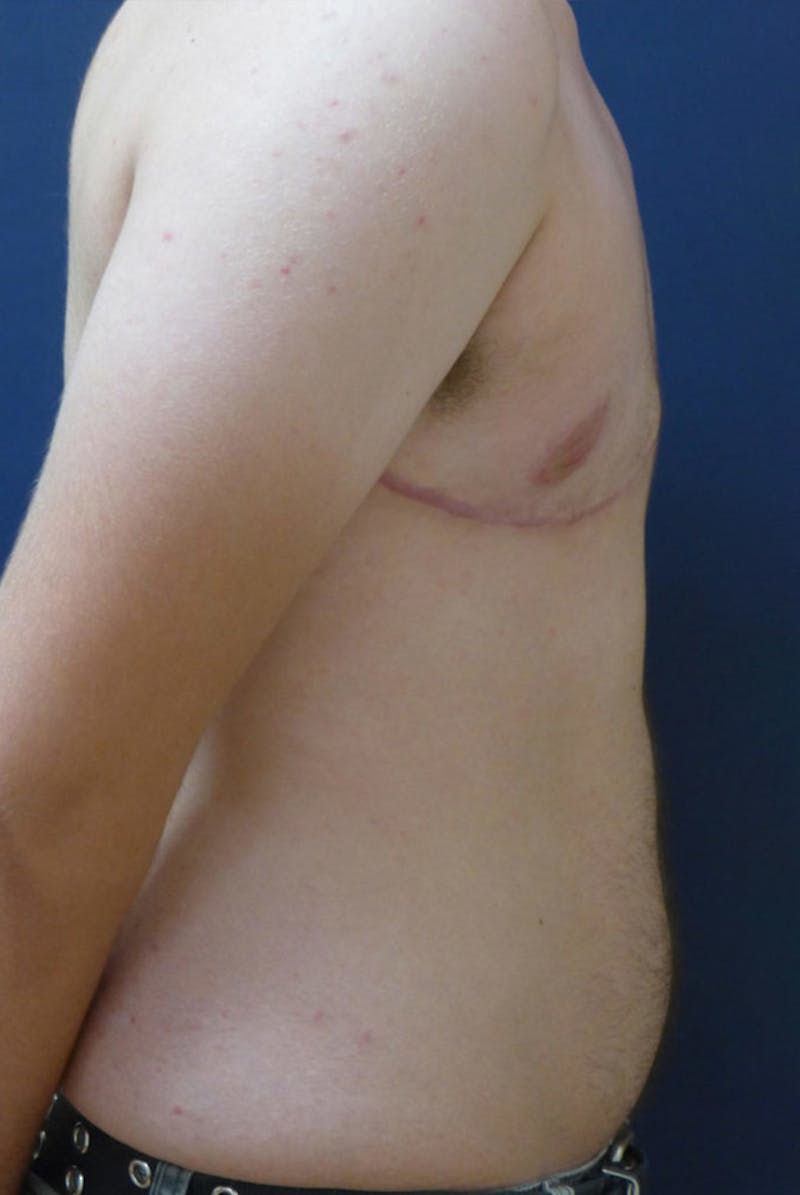 Masculinizing Surgery Before & After Gallery - Patient 206600 - Image 4
