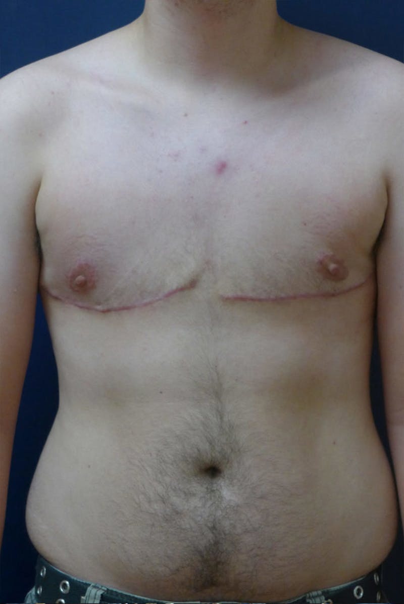 Masculinizing Surgery Before & After Gallery - Patient 206600 - Image 2