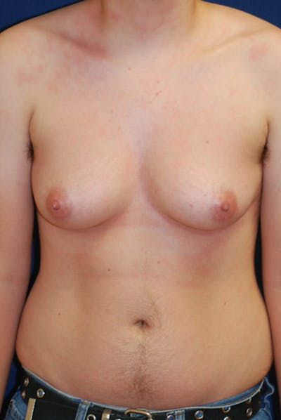 Masculinizing Surgery Before & After Gallery - Patient 206600 - Image 1
