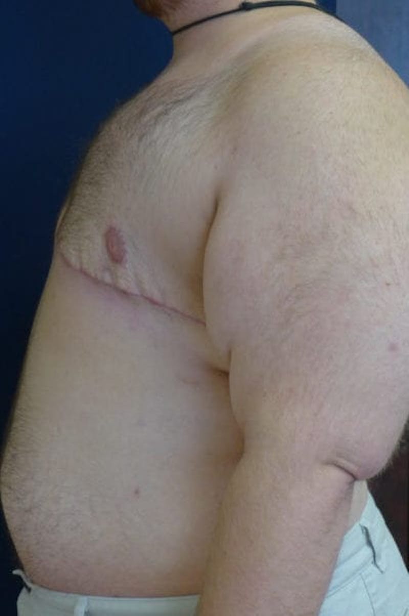Masculinizing Surgery Before & After Gallery - Patient 256142 - Image 4