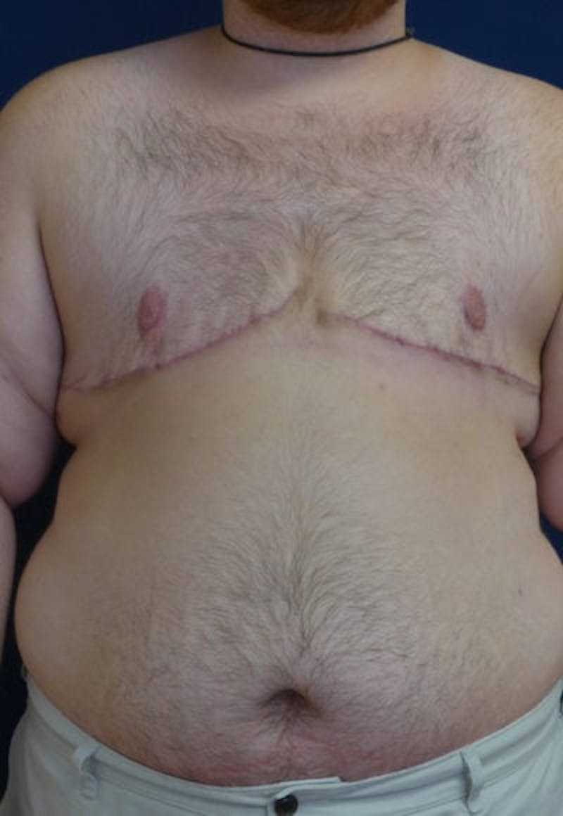 Masculinizing Surgery Before & After Gallery - Patient 256142 - Image 2
