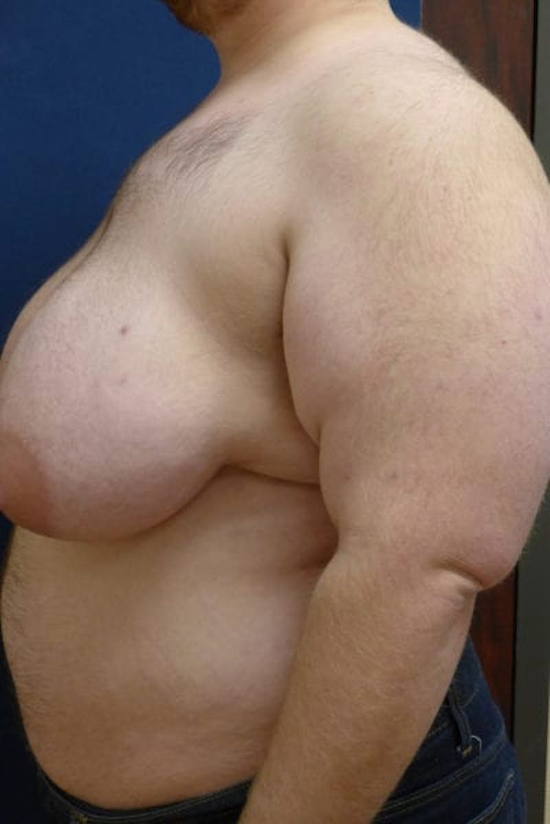 Masculinizing Surgery Before & After Gallery - Patient 256142 - Image 3