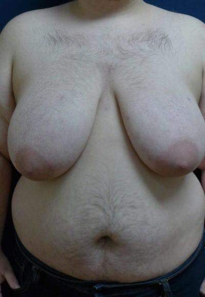 Masculinizing Surgery Before & After Gallery - Patient 256142 - Image 1