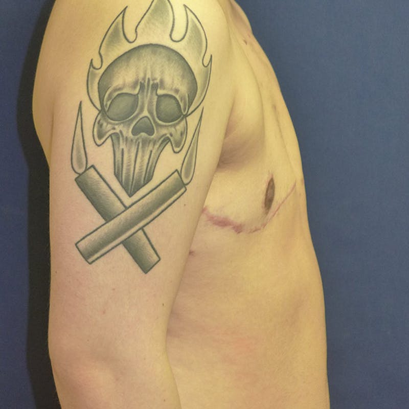 Masculinizing Surgery Before & After Gallery - Patient 829505 - Image 10