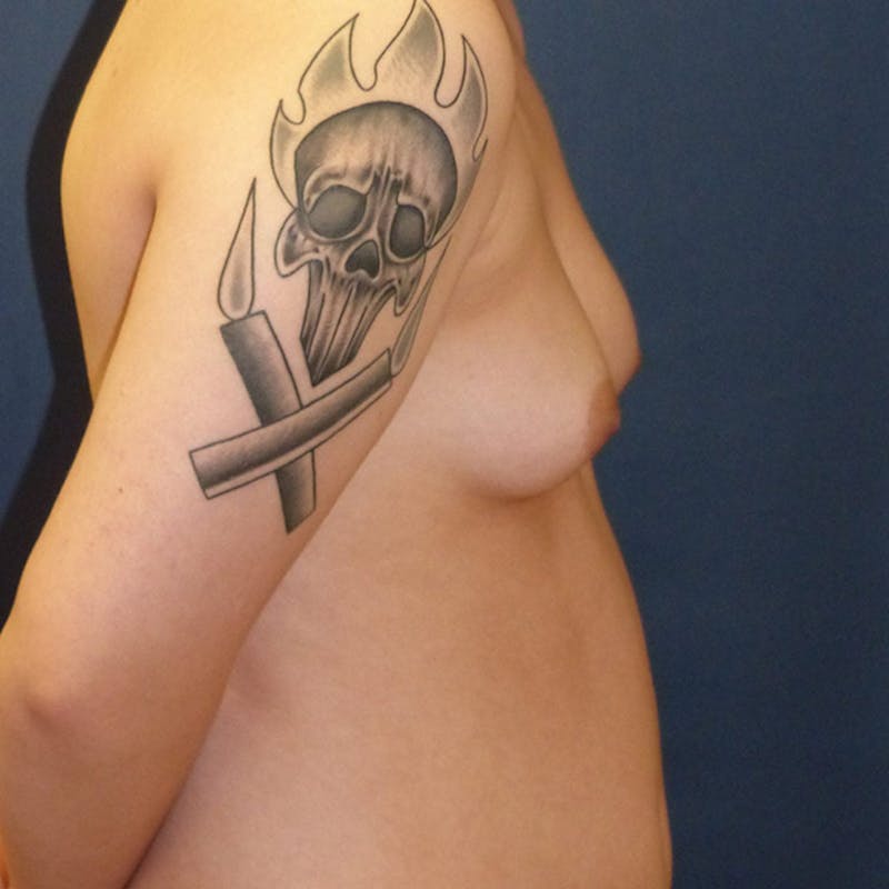 Masculinizing Surgery Before & After Gallery - Patient 829505 - Image 9