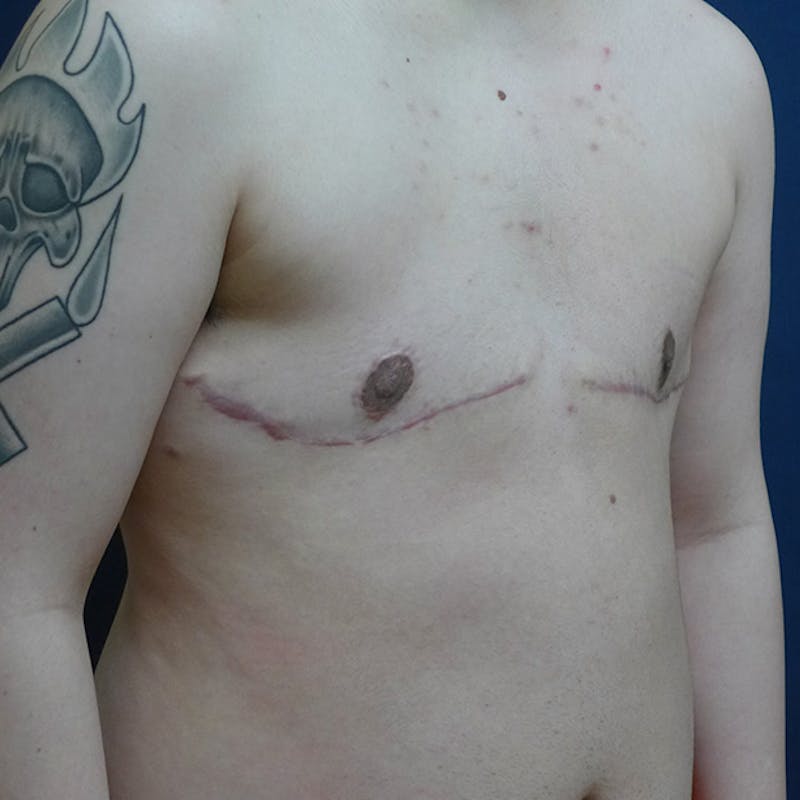 Masculinizing Surgery Before & After Gallery - Patient 829505 - Image 8