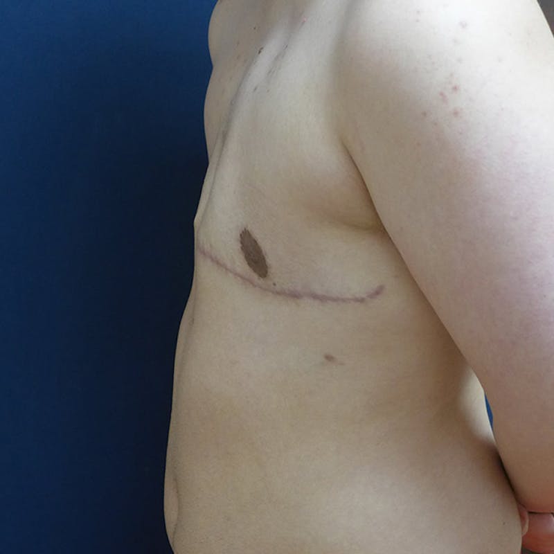Masculinizing Surgery Before & After Gallery - Patient 829505 - Image 6