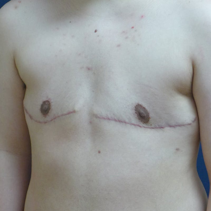 Masculinizing Surgery Before & After Gallery - Patient 829505 - Image 4