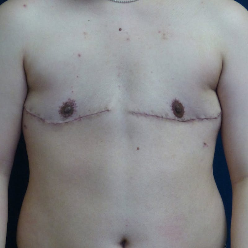 Masculinizing Surgery Before & After Gallery - Patient 829505 - Image 2