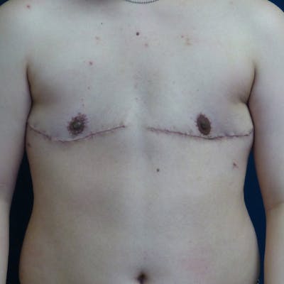 Masculinizing Surgery Before & After Gallery - Patient 829505 - Image 2