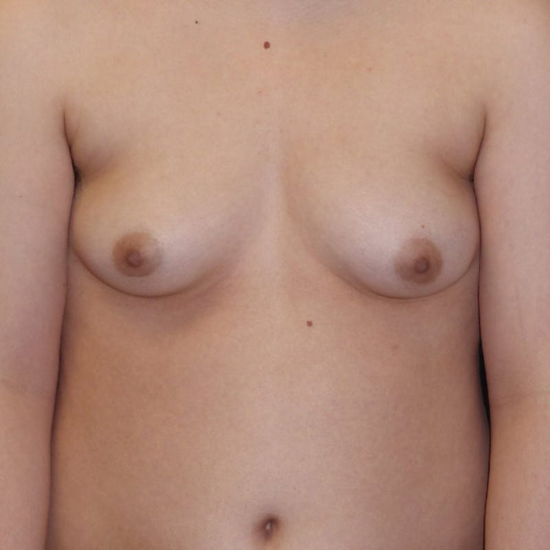 Masculinizing Surgery Before & After Gallery - Patient 829505 - Image 1