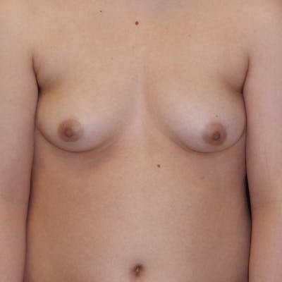 Masculinizing Surgery Before & After Gallery - Patient 829505 - Image 1