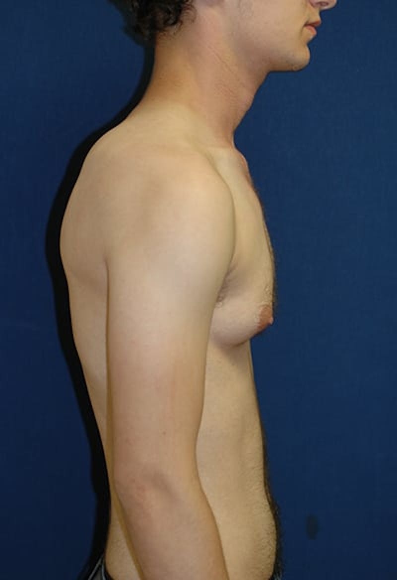 Masculinizing Surgery Before & After Gallery - Patient 177224 - Image 7
