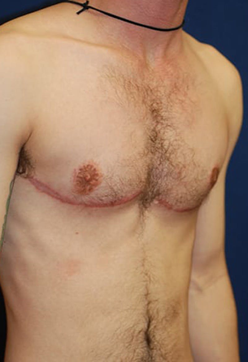 Masculinizing Surgery Before & After Gallery - Patient 177224 - Image 6