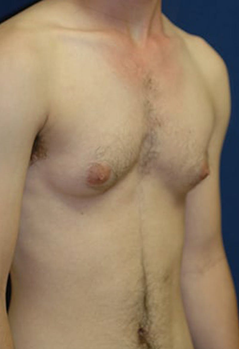 Masculinizing Surgery Before & After Gallery - Patient 177224 - Image 5