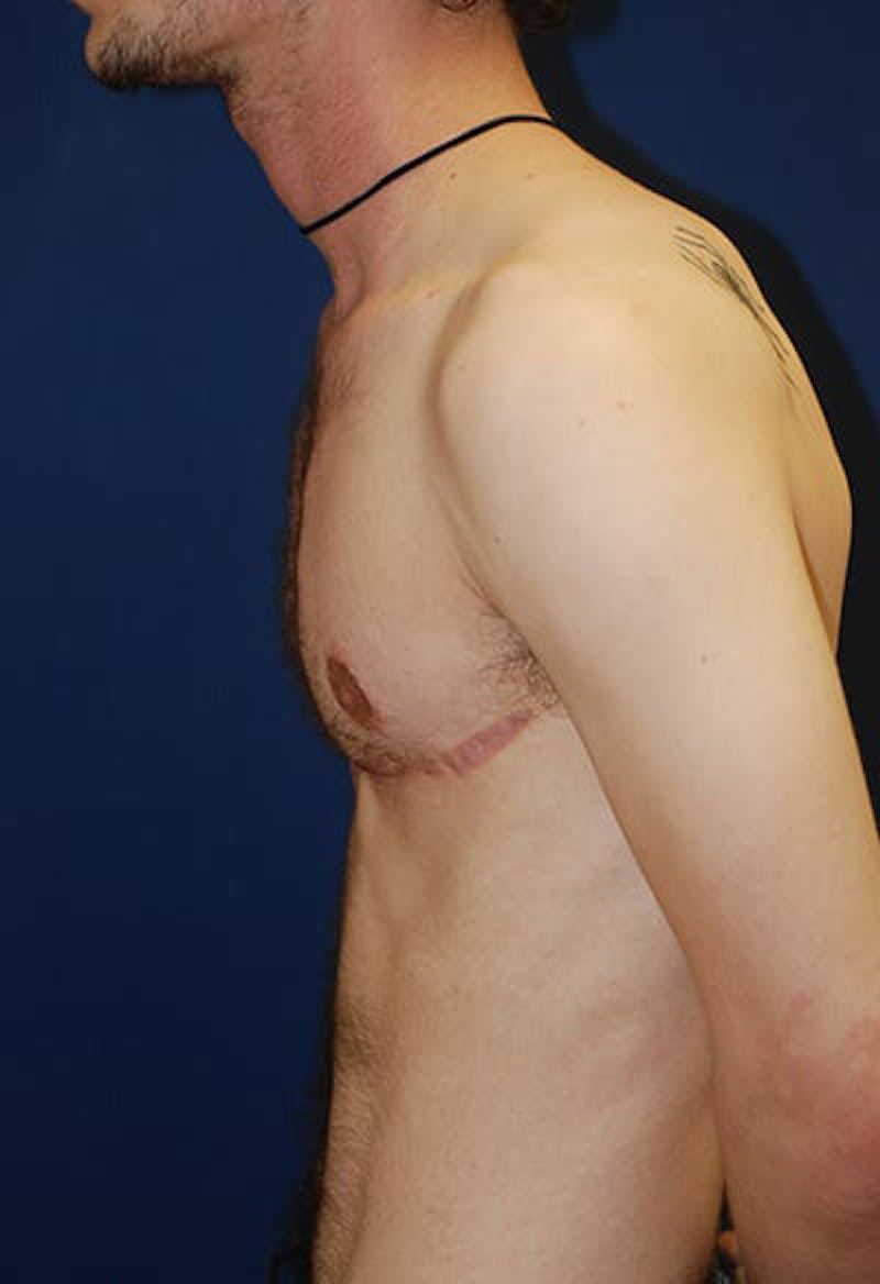 Masculinizing Surgery Before & After Gallery - Patient 177224 - Image 4