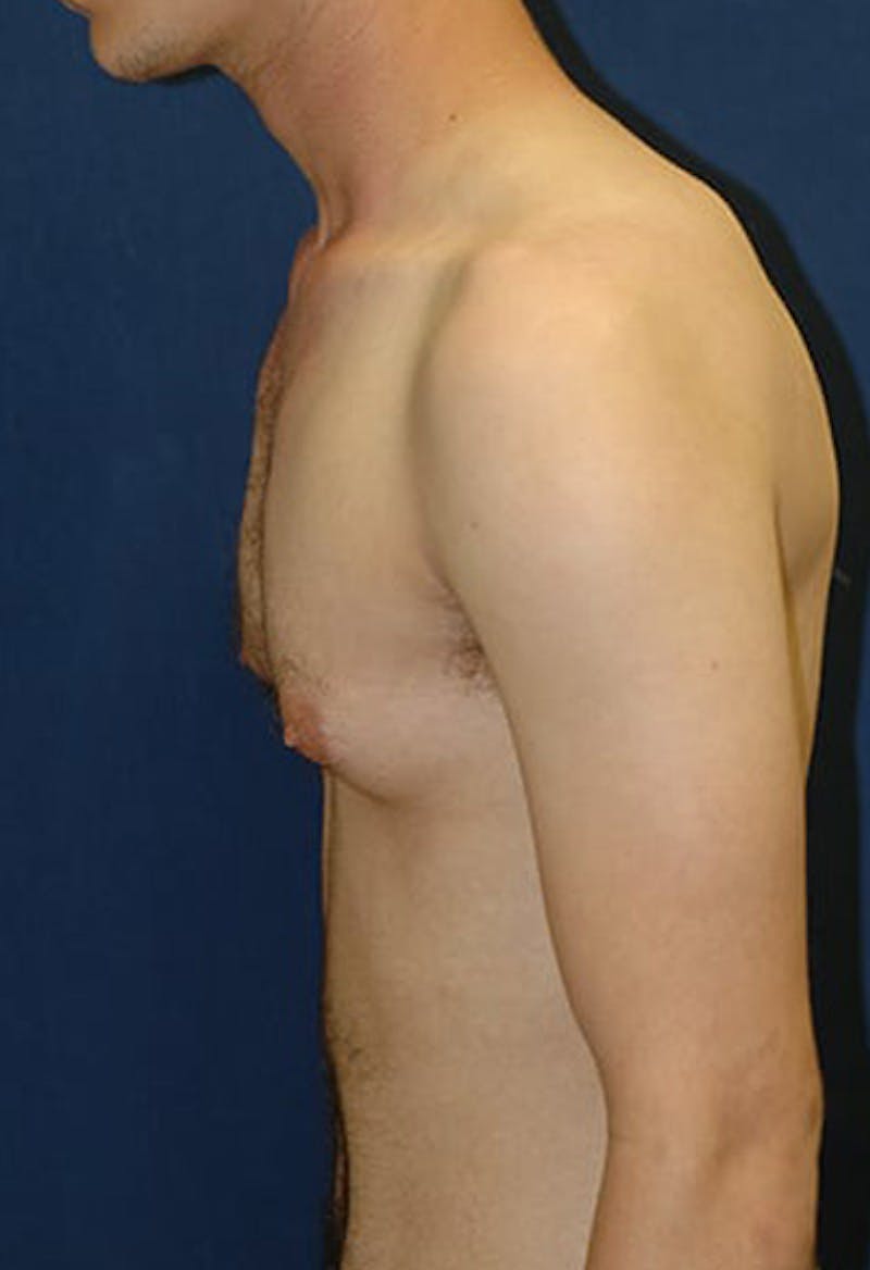 Masculinizing Surgery Before & After Gallery - Patient 177224 - Image 3