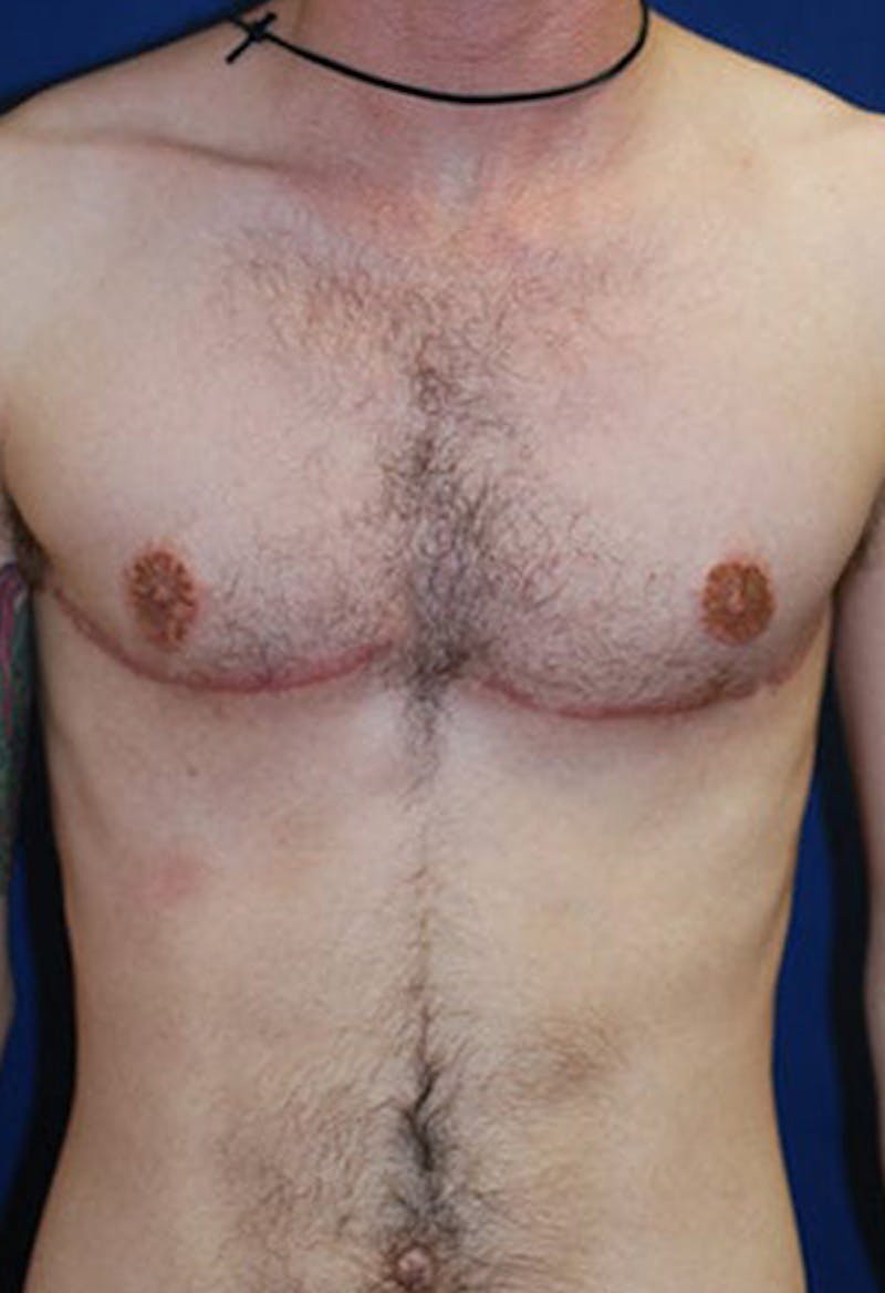 Masculinizing Surgery Before & After Gallery - Patient 177224 - Image 2
