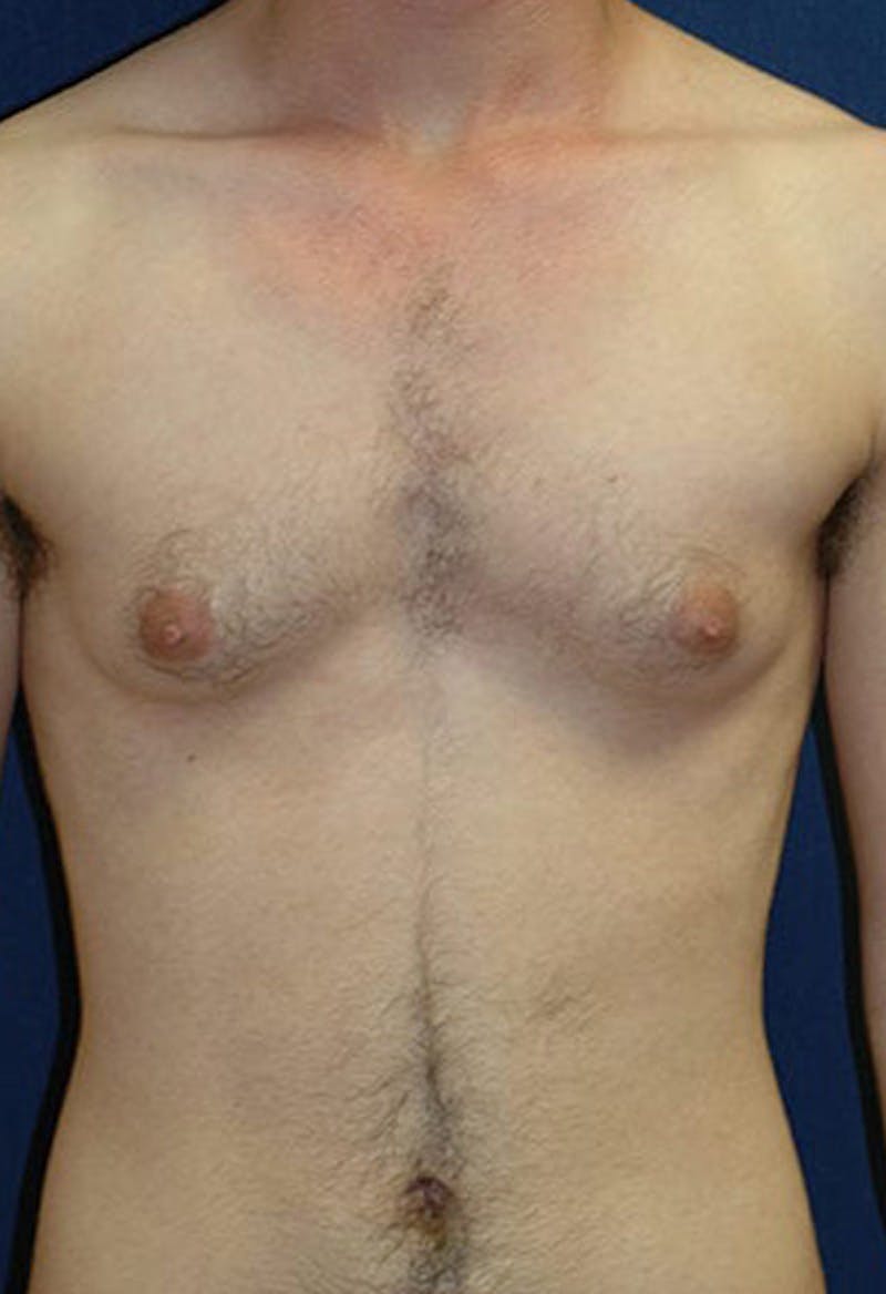 Masculinizing Surgery Before & After Gallery - Patient 177224 - Image 1