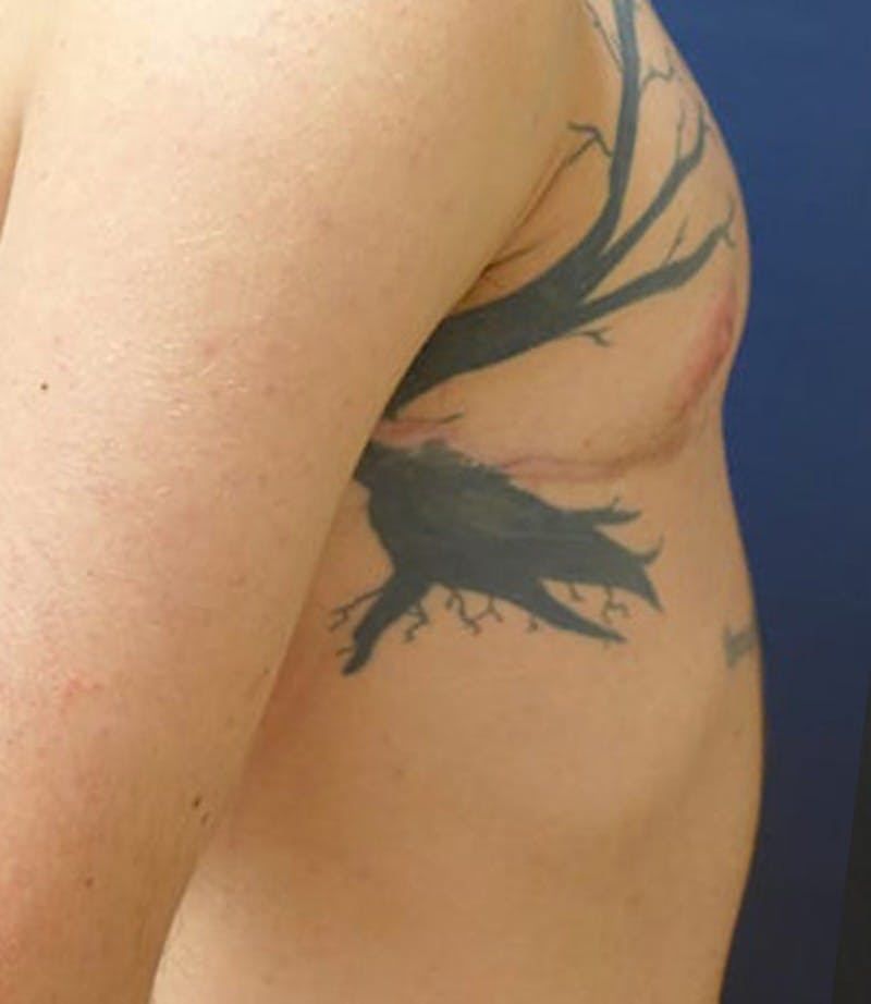 Masculinizing Surgery Before & After Gallery - Patient 872485 - Image 6