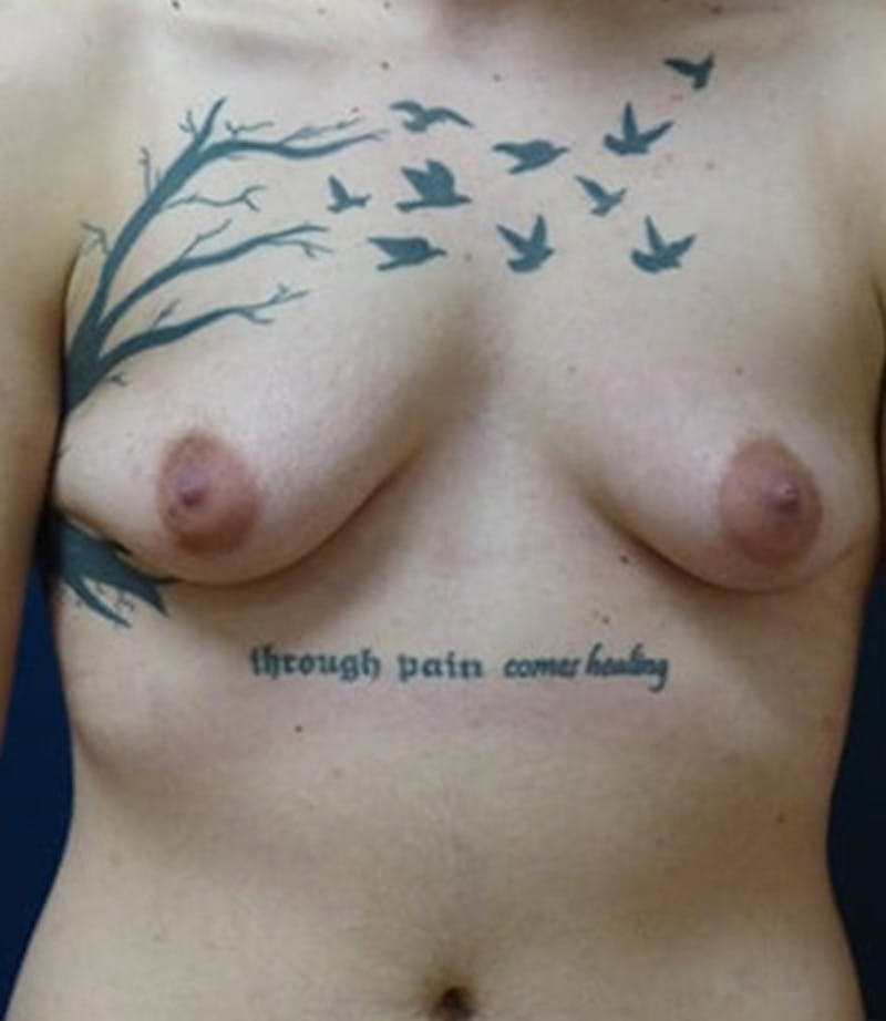 Masculinizing Surgery Before & After Gallery - Patient 872485 - Image 3