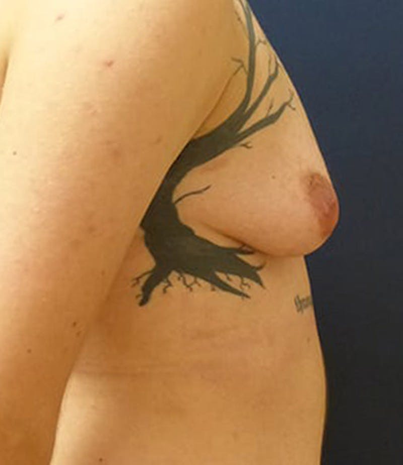 Masculinizing Surgery Before & After Gallery - Patient 872485 - Image 5