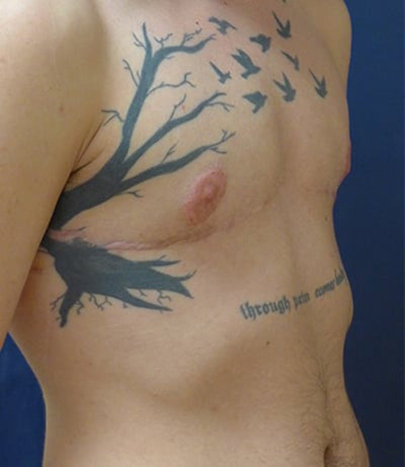 Masculinizing Surgery Before & After Gallery - Patient 872485 - Image 2