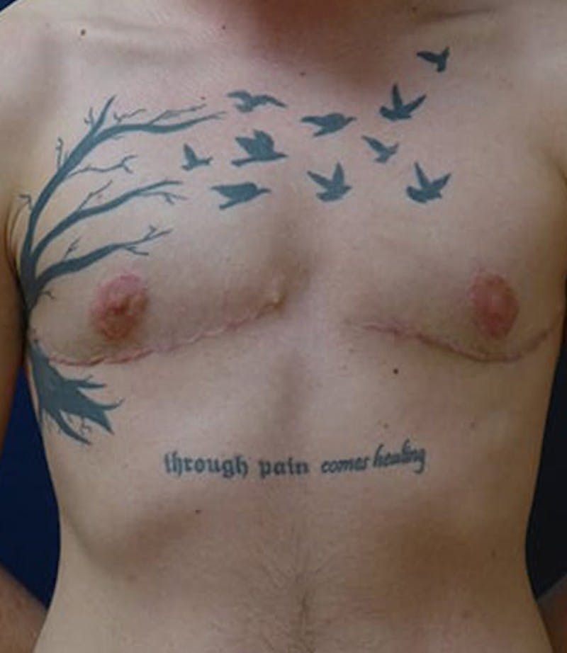 Masculinizing Surgery Before & After Gallery - Patient 872485 - Image 4