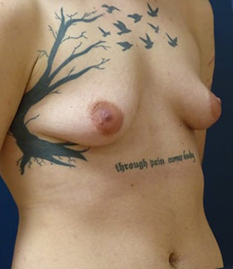 Masculinizing Surgery Before & After Gallery - Patient 872485 - Image 1