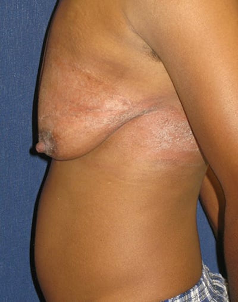 Masculinizing Surgery Before & After Gallery - Patient 235468 - Image 2