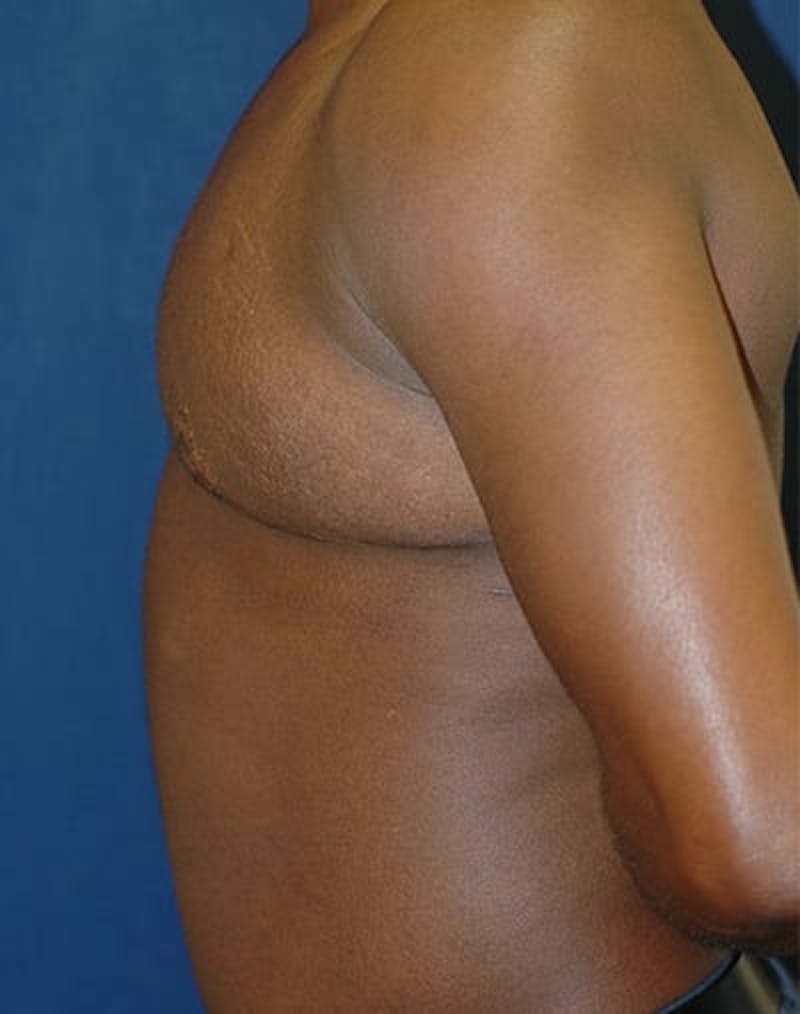 Masculinizing Surgery Before & After Gallery - Patient 235468 - Image 3
