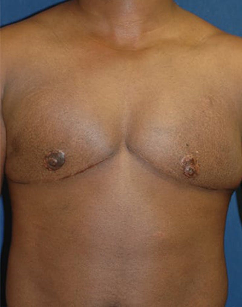 Masculinizing Surgery Before & After Gallery - Patient 235468 - Image 1