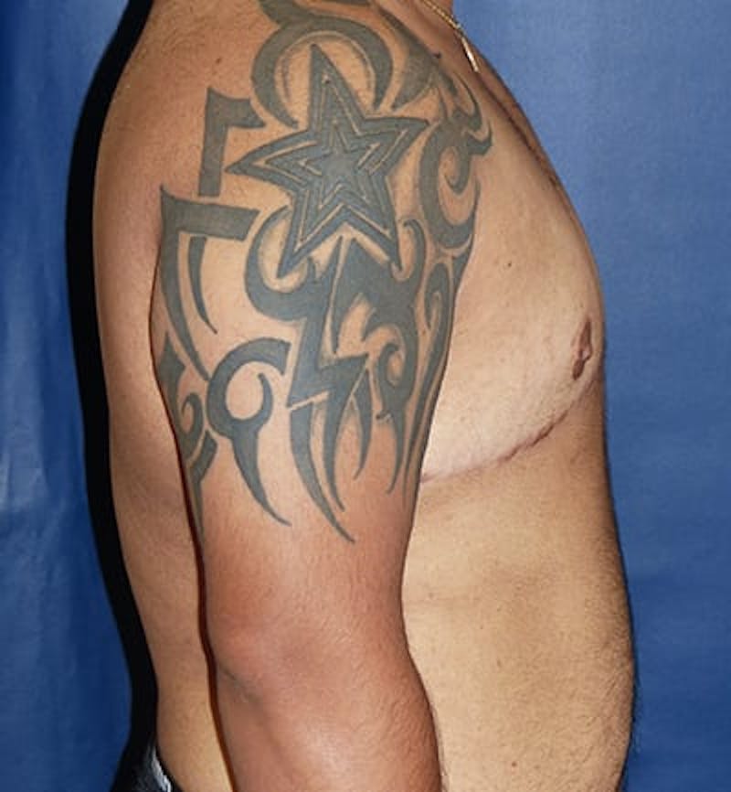 Masculinizing Surgery Before & After Gallery - Patient 675792 - Image 4